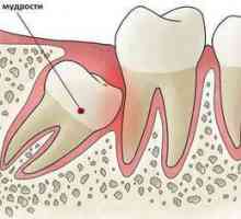 Extracție dentară pe maxilarul superior