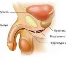 Urethrită la bărbați: simptome și tratament