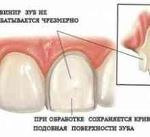 Furnizorii pe dinți: ce este, tipurile, descrierea și modul de a le pune