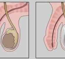 Testiculele picante: ce amenințare este apariția fluidului în scrot