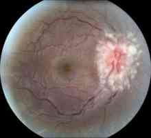 Inflamația dzn - edemul nervului optic