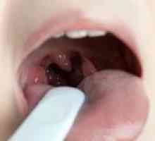 Inflamația amigdalelor în gât: cauze, simptome și tratament