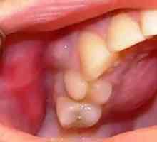 Inflamația periostului dintelui: tratament, simptome de periostită