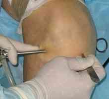 Restaurare după operația de artroscopie a articulației genunchiului: recenzii