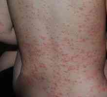 Erupțiile pe piele cu afecțiuni hepatice, care sunt acestea?