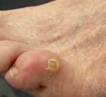 Boli ale tălpilor picioarelor: cum se vindecă calusele uscate