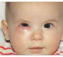 Ocluzia la nou-născuți a canalului lacrimal: cauze și tratament