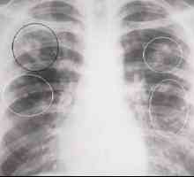 Este tuberculomul plămânilor și care sunt consecințele acestora?