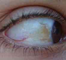 Punct galben în ochi: cauzele apariției și tratamentului
