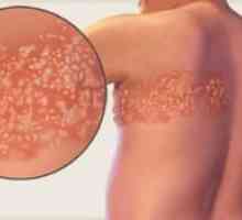 Familiarizarea cu herpes zoster: simptome și tratament