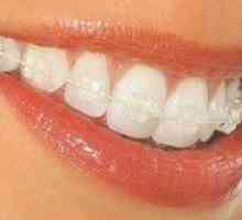 Sistemul suportului dinților: caracteristicile sistemelor și instalarea acestora