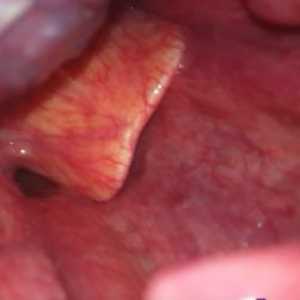 Abcesul de epiglottis la copilul fotografie