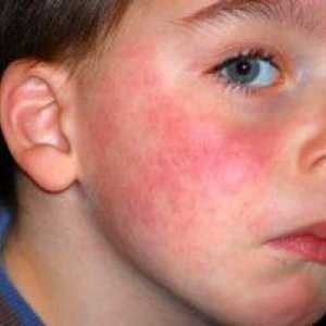 Alergia la lapte la un copil, simptome și dezvoltare