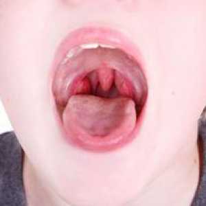 Angina la adulți: simptome și fotografii ale durerilor în gât