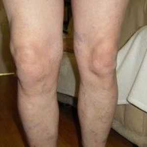 Osteoartrita articulației genunchiului: simptome, tratament, fotografie