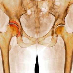Osteoartrita articulației șoldului 1 și 2 grade: metode de tratament