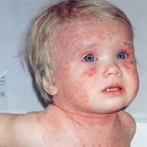 Dermatită atopică la un copil cu o fotografie