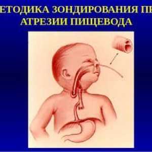 Atrezia esofagului la nou-născuți