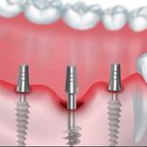 Implantarea bazală: avantajele implantării bazale a dinților