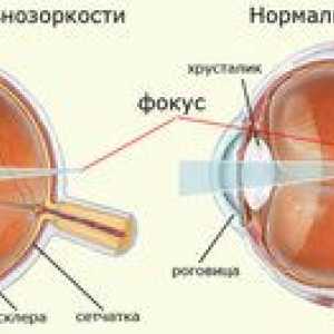 Micopie, hipermetropie. De ce razele nu se concentrează pe retină?