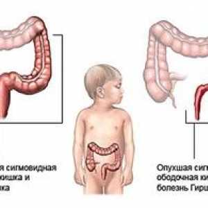 Boala lui Hirschsprung la simptomele copiilor