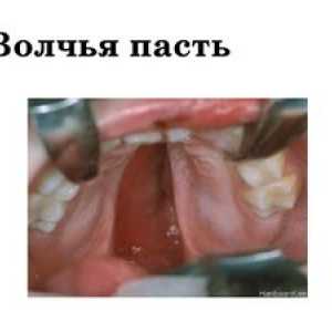 Boala "lup" gura la copii: cleft palatului