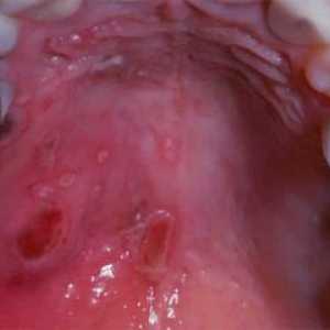 Palatul gurii este dureros: cauze și tratament