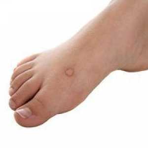Negi pe picioare: formațiuni foto pe picioare și tratamentul acestora