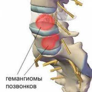 Ce este - hemangiomul spinării, căile de tratament