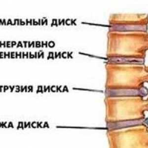Ce este - proeminența discurilor coloanei vertebrale și cum să le tratezi