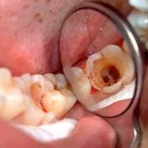 Ce este pulpita: simptome și tratament dentar?