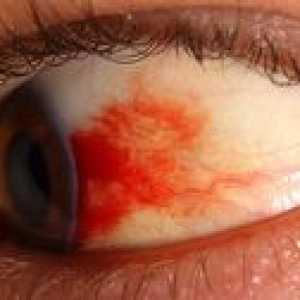 Ce este această retinopatie a ochiului: tipurile, simptomele și tratamentul