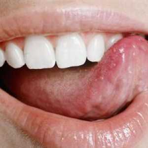 Care sunt leziunile albe din gură?