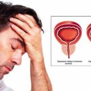 Ce este adenomul de prostată la bărbați: cauze, simptome și tratament