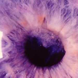 Ce este aphakia, trăsături ale acestei patologii a ochiului