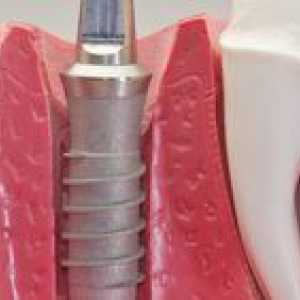 Ce este implantarea dinților și instalarea implantului