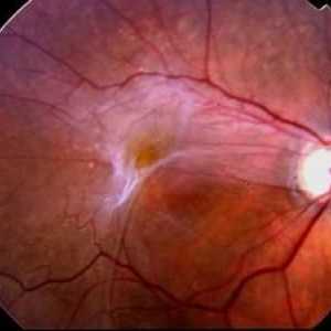 Ce este fibroza oculară epiretinală?