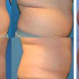 Ce este liposucția: tipurile, plusurile și minusurile procedurii
