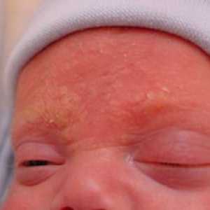Ce este dermatita seboreică la copii?