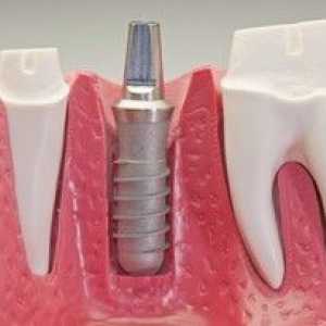 Ce sunt implanturile dentare: tipuri și descriere