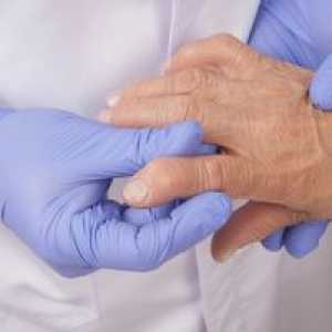 Ce arthritis boală și cum să o tratezi