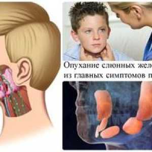 Ce o boală oreion epidemie: simptome și tratament