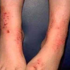 Dermatita la copii pe picioare: fotografii, tipuri și moduri de tratament