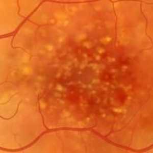 Dystrofia retinei: ceea ce este, simptomele unei boli