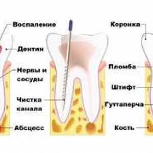Durerea dentară lungă după îndepărtarea nervului