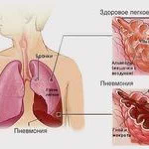 Pneumonie pe două fețe: cum să vindeciți pneumonia?