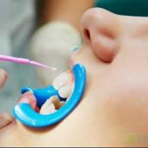 Fluorizarea dinților la copii: beneficiu, preț