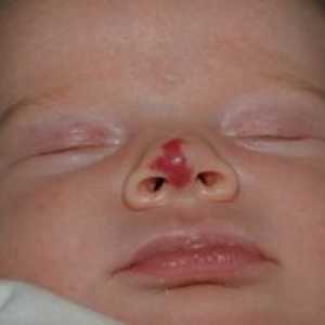 Hemangiomul la nou-născut: fotografii și soiuri