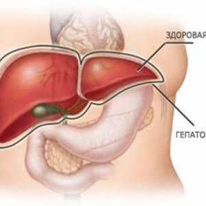 Hepatomegalia ficatului: ce este și cum trebuie tratată