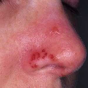 Herpesul pe nas: metode pentru tratarea răcelilor, foto